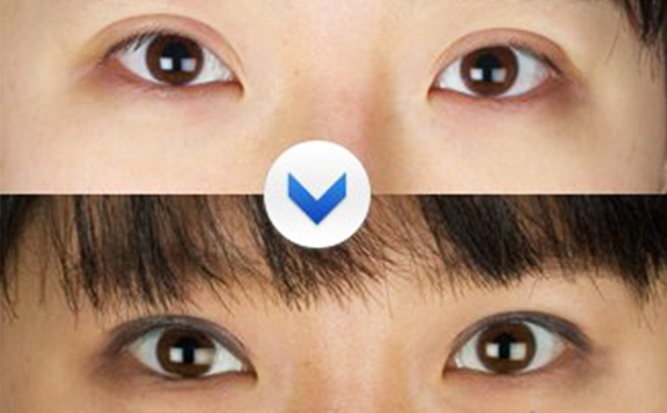 雙眼皮術(shù)后為什么不自然?怎樣避免肉條感?