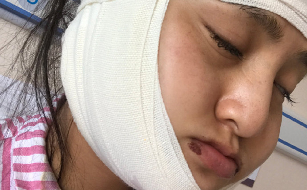 上海首爾麗格樸興植下頜角截骨手術(shù)案例術(shù)后三天