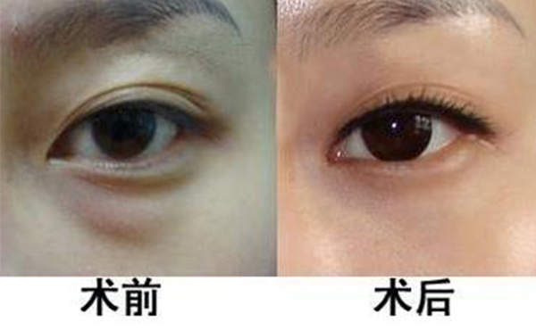 眼袋抽脂適合哪些人？