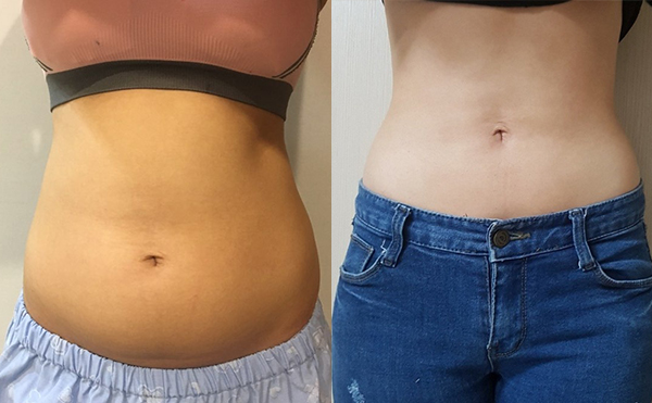 腰腹吸脂的效果好嗎？