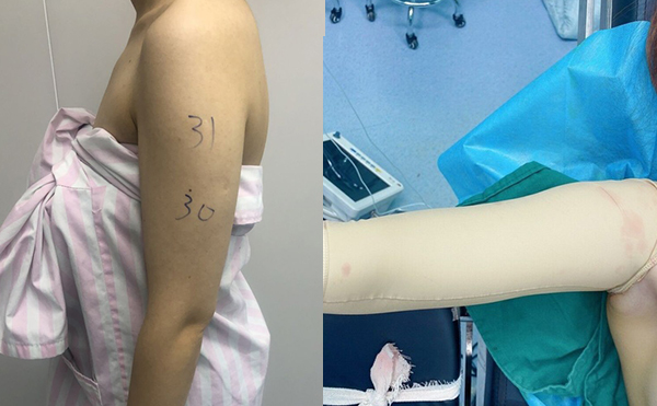 手臂吸脂安全嗎？