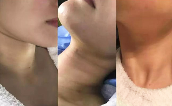 激光去頸紋多少錢？