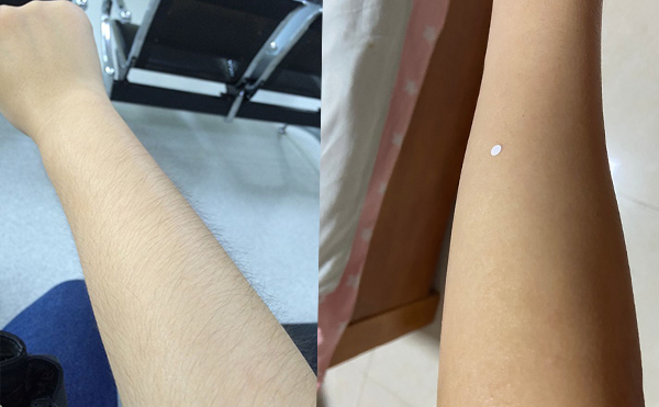 激光手臂脫毛價(jià)格貴不貴？