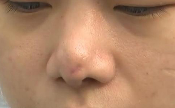 如果更換隆鼻假體，當(dāng)天可以直接換嗎?