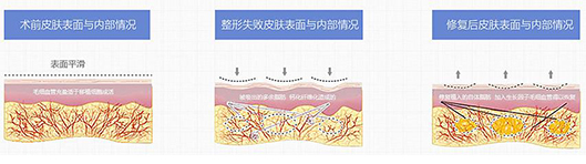 皮下脂肪示意圖