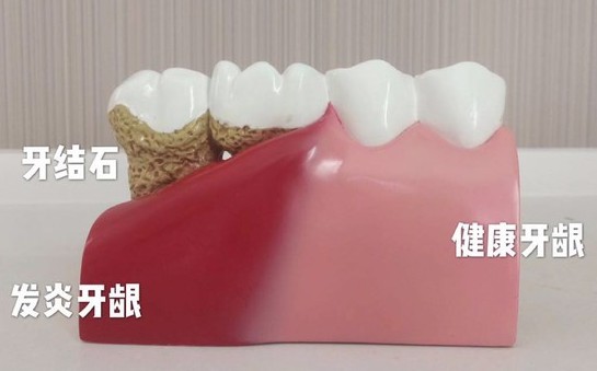 洗完牙后牙齒會(huì)變得敏感？