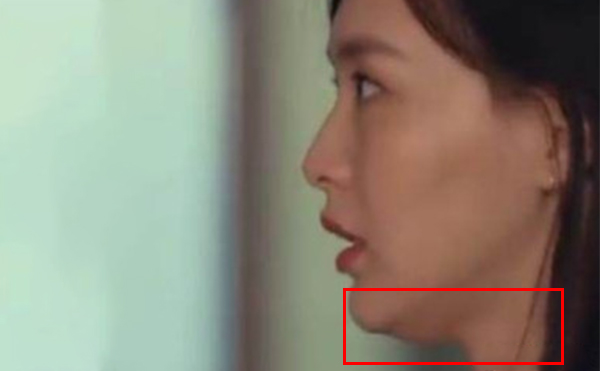 面部輪廓整形后是否會出現(xiàn)皮膚松弛下垂取決于哪些方面?