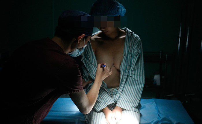 目前哪種隆胸最安全？假體隆胸哪種植入方法最好？