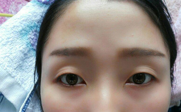 眼瞼凹陷怎么回事？眼瞼凹陷用什么填充最合適？