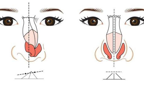 歪鼻矯正手術(shù)大概多少錢？歪鼻矯正手術(shù)成功率為多少？