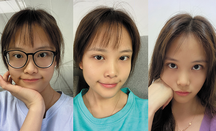 埋線提升案例效果對(duì)比圖2