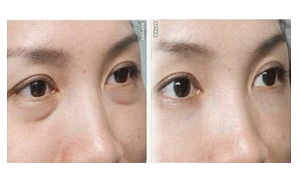 吸脂去眼袋有什么優(yōu)勢？