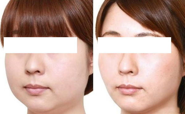 面部吸脂術(shù)適合哪些人群？