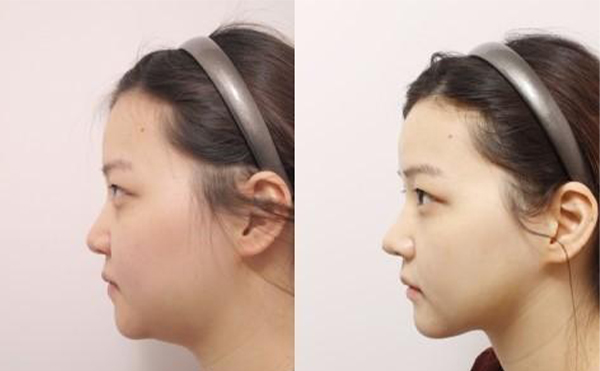 五類建議做下巴整形的下巴，快看看有沒有你