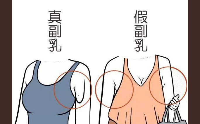 多乳癥是什么癥狀？