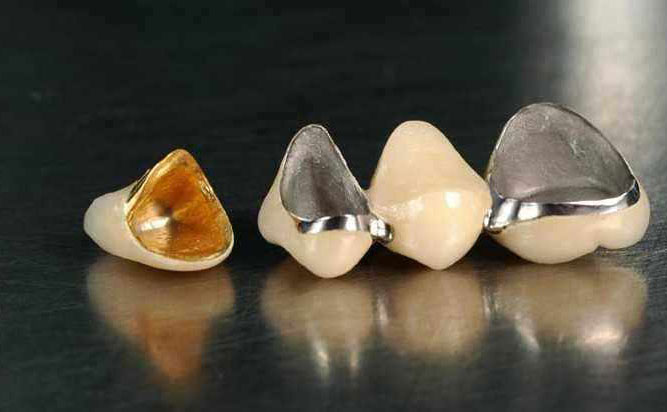 貴金屬烤瓷牙多少錢(qián)一顆？