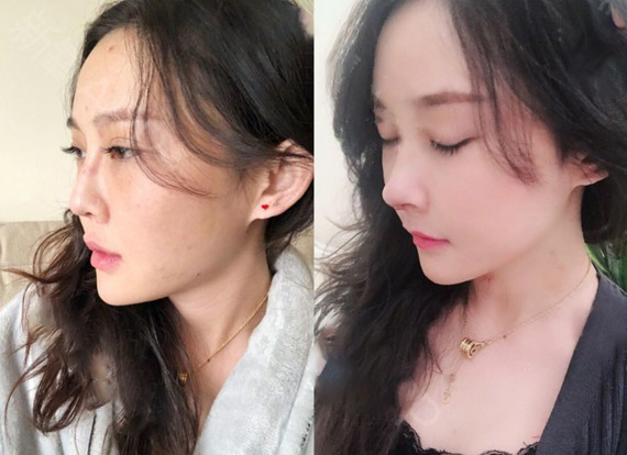 肋骨隆鼻手術效果圖2