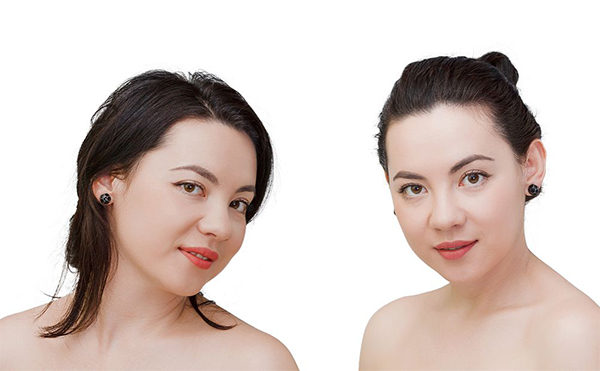 常見的瘦臉方式有哪些?建議選擇哪種方式?