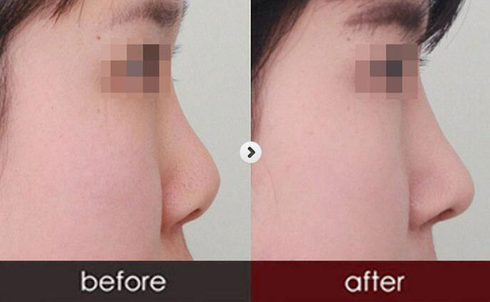 硅膠隆鼻一般需要多少錢呢？