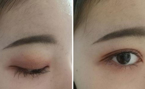 割雙眼皮的危害是什么？