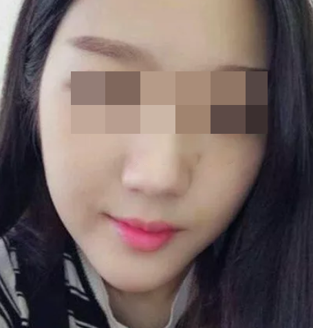 墊下巴手術(shù)效果圖