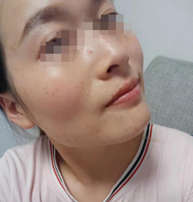 術(shù)后三天祛斑案例效果對比