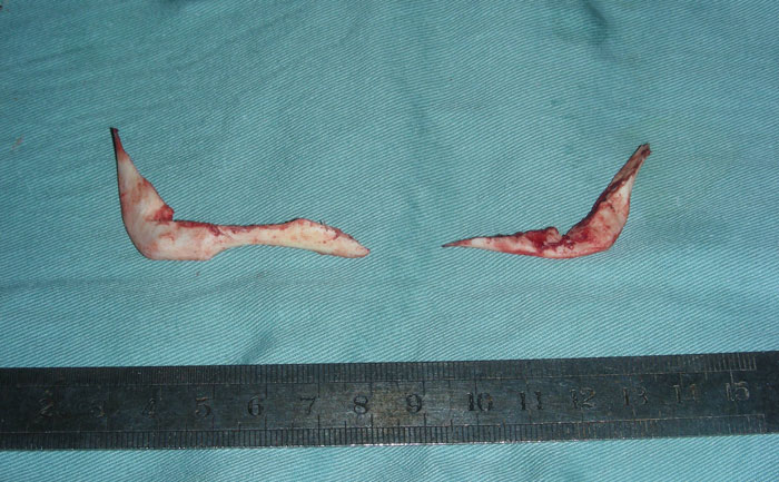 切除下頜角瘦臉方法安全嗎？手術(shù)的優(yōu)勢(shì)有哪些？