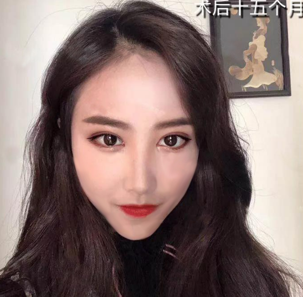 微創(chuàng)雙眼皮術(shù)后十五個(gè)月效果