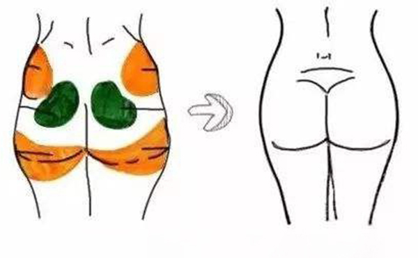 自體脂肪豐臀價(jià)格多少?會反彈嗎?