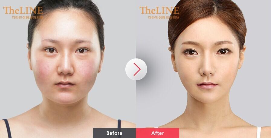 削臉頰骨需要多少錢？削臉頰骨成功率高嗎？