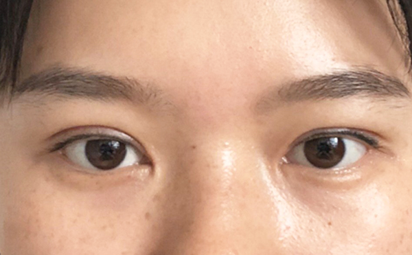 大小眼怎么改善?大小眼矯正多少錢(qián)?