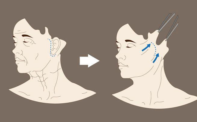 電波拉皮一次大概多少錢？