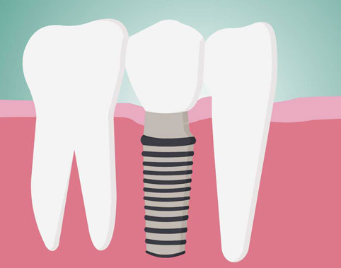 牙齒修復(fù)多少錢(qián)一顆？