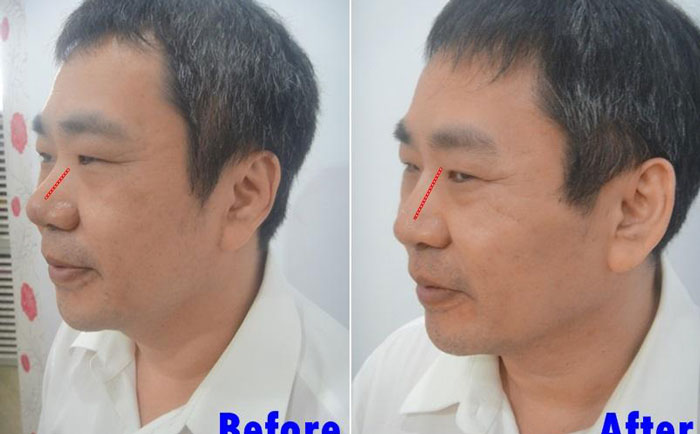 男性隆鼻子大概多少錢？