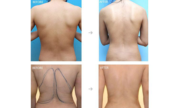 背部吸脂能維持多久？