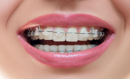 隱形牙套多久換一副？