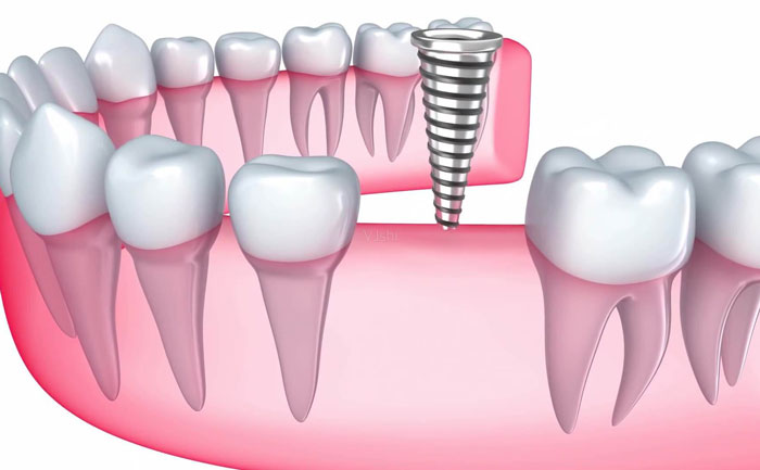 牙齒種植大概費用是多少？牙齒種植多少錢一顆