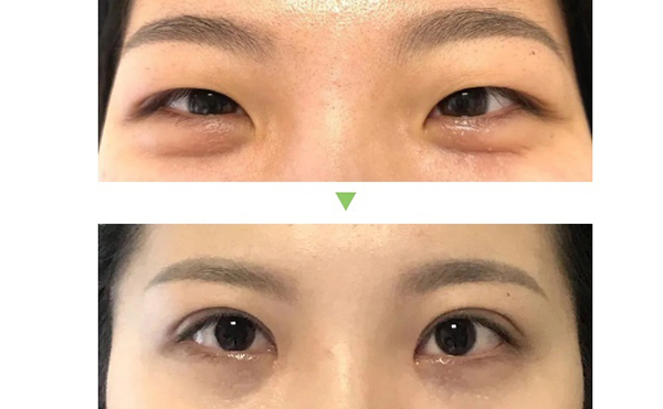 雙眼皮手術(shù)的種類及優(yōu)缺點(diǎn)是什么?術(shù)后怎么護(hù)理效果好?