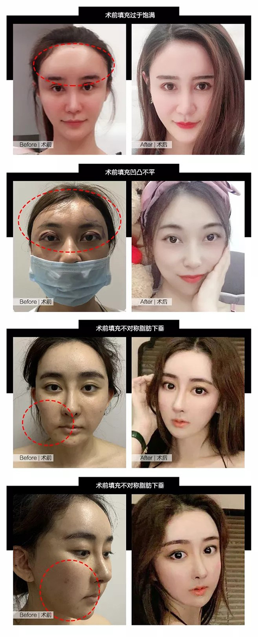 脂肪填充手術(shù)效果對比圖