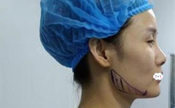 下頜角整容整形費(fèi)用怎么算?要多少錢?