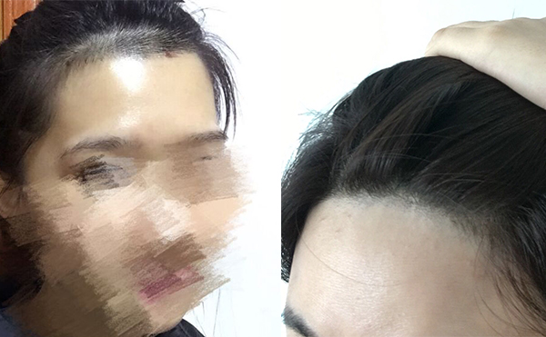 冰點面部脫毛有沒有疼痛感？