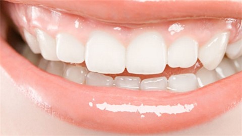 虎牙矯正需要多久？