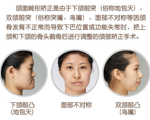 正頜手術(shù)真實(shí)分享