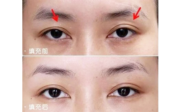 眼瞼凹陷矯正過程是什么?眼瞼凹陷矯正需要多少錢?