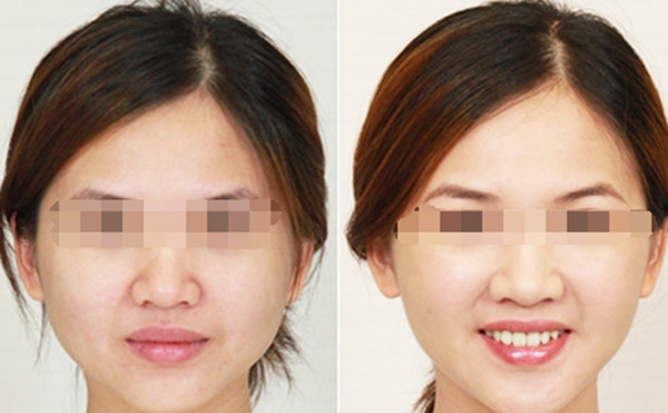 瘦臉針的效果怎么樣？