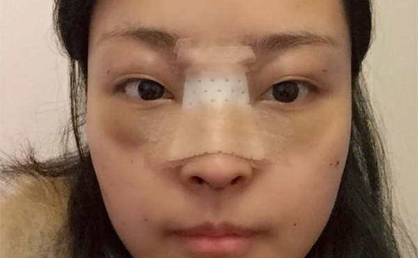 隆鼻修復手術一般多少錢?