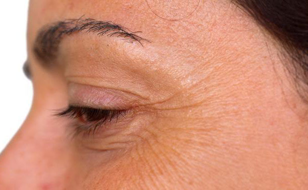 眼角紋怎么消除簡單方法？眼角紋去除要多少錢？