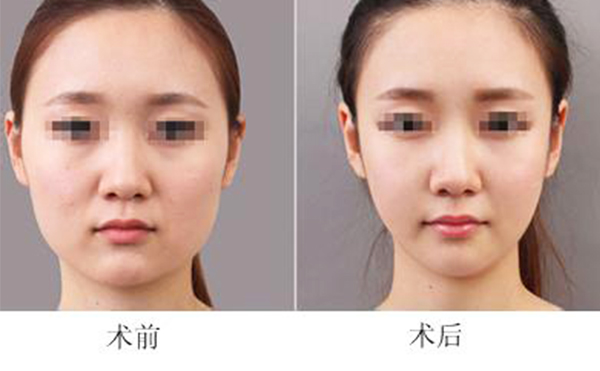 面部吸脂會導(dǎo)致臉下垂嗎？