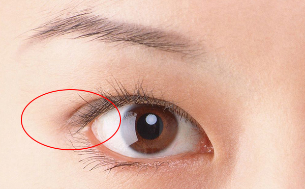 開外眼角價格多少錢?開外眼角術后怎么護理?