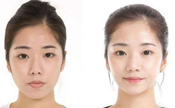 面部吸脂瘦臉的副作用？